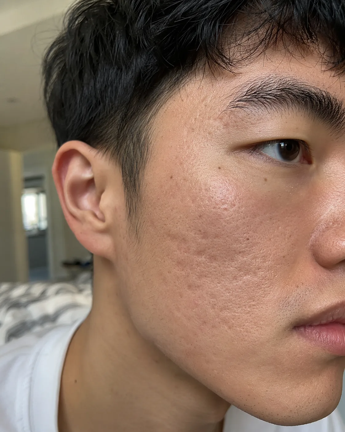 Pitted acne scars on male face