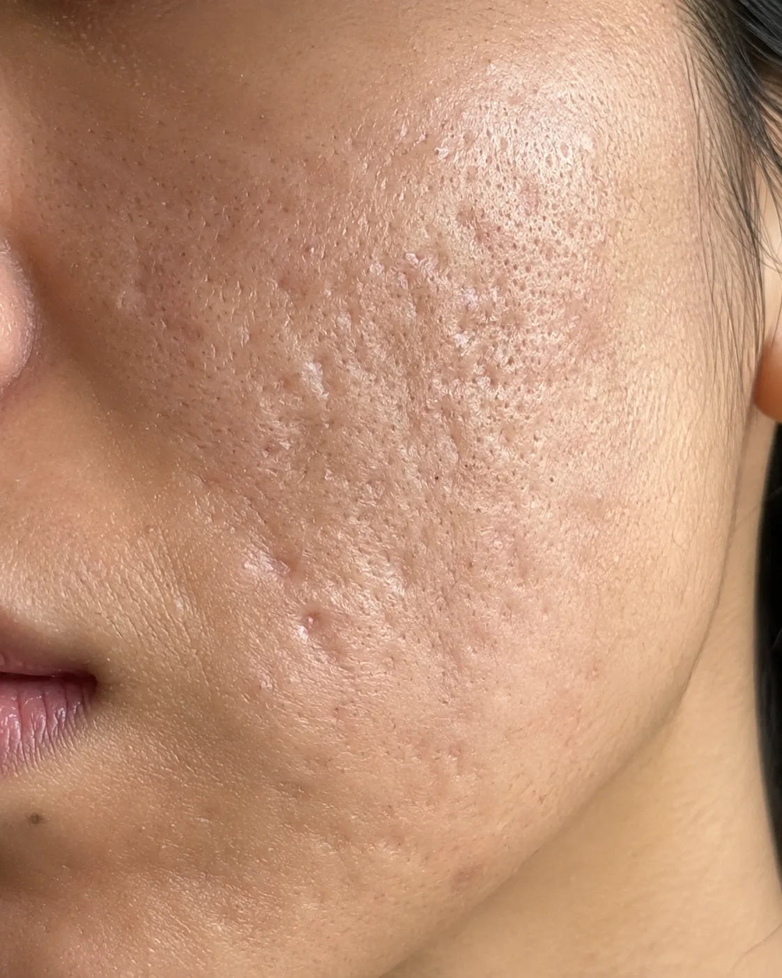 Extreme closeup of female pitted scars