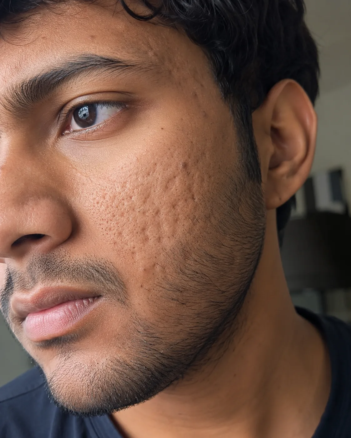 Cheek pitted scars closeup